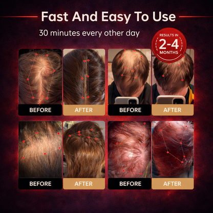 🔥Last Day:63% off 🔥Red Light Therapy Regrowth Cap